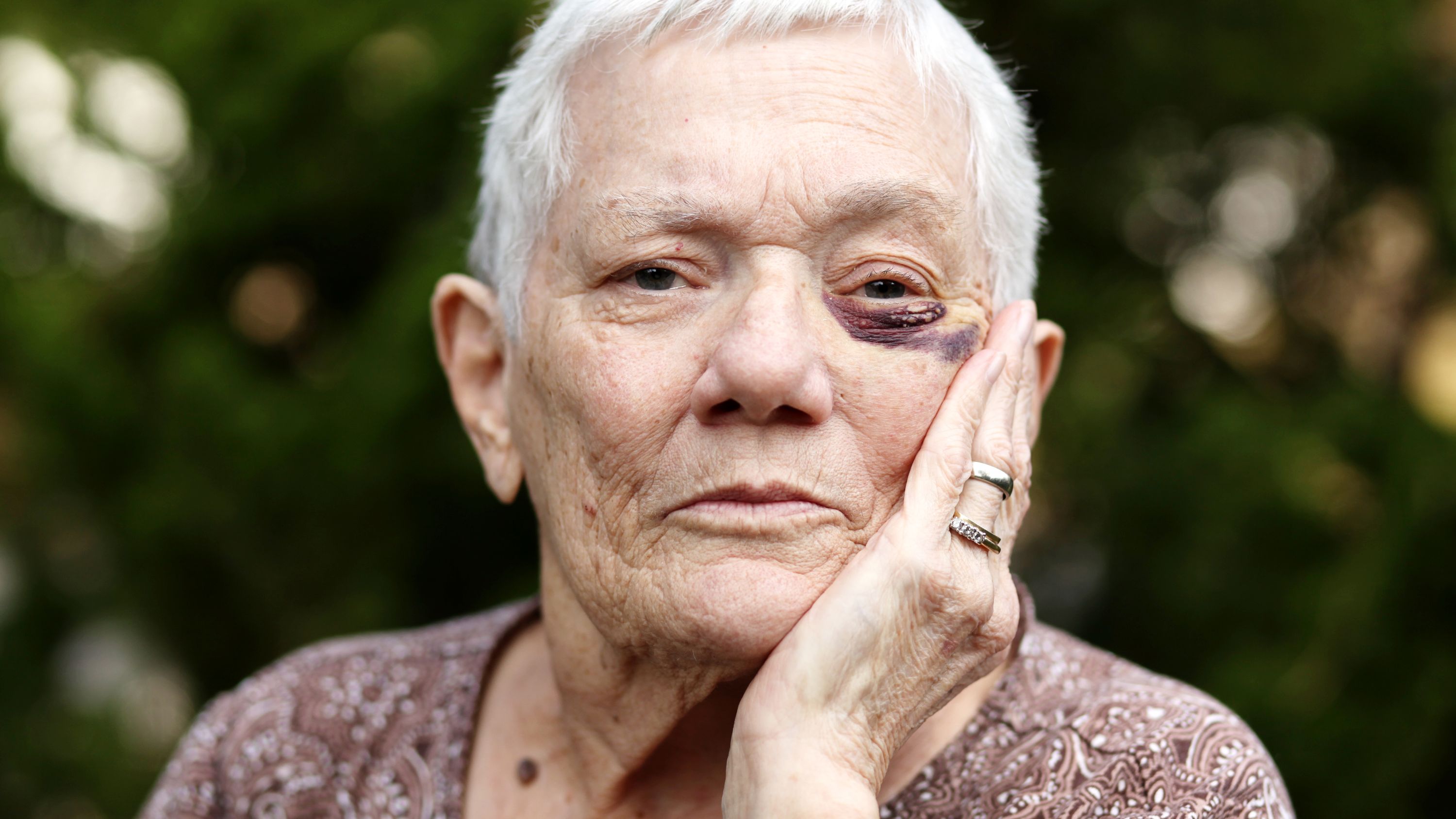 Un’anziana con un occhio nero.